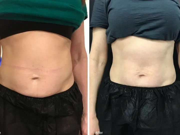 What to Expect of First Fat Freezing Session What to Expect of First Fat Freezing Session