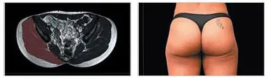 Before & After EMsculpt Treatment in Melbourne